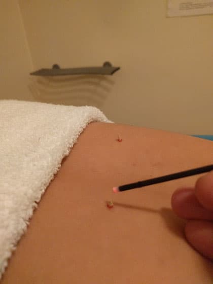 Moxa(moxibustion)